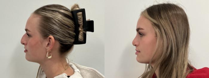 Before & After Rhinoplasty Case 496 Left Side View in Albany, Latham & Saratoga, New York