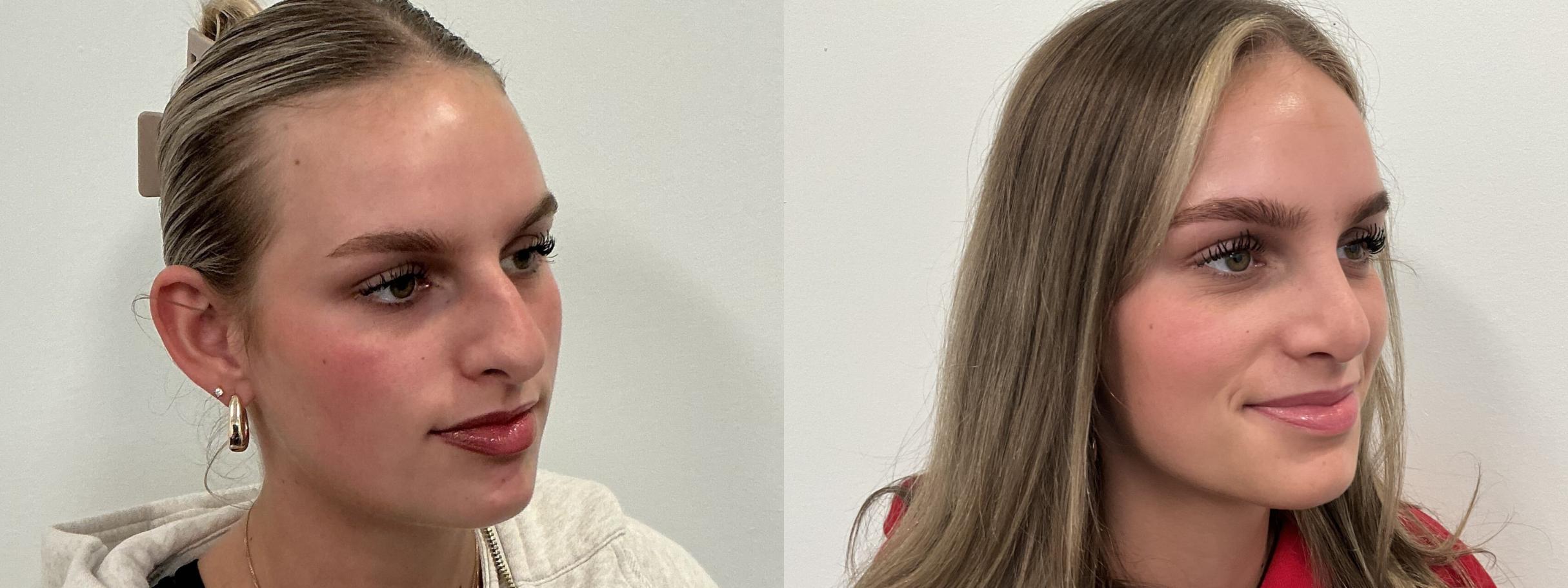 Before & After Rhinoplasty Case 496 Right Oblique View in Albany, Latham & Saratoga, New York