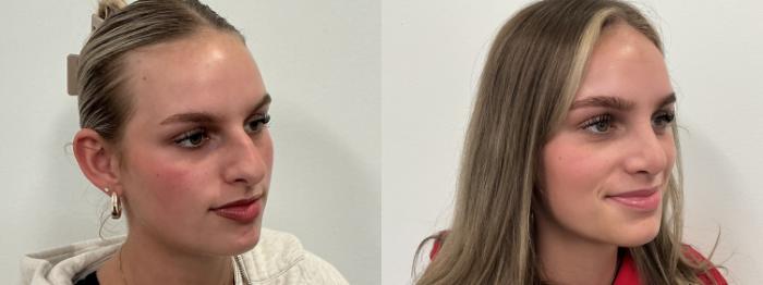 Before & After Rhinoplasty Case 496 Right Oblique View in Albany, Latham & Saratoga, New York