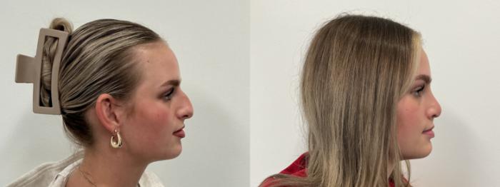 Before & After Rhinoplasty Case 496 Right Side View in Albany, Latham & Saratoga, New York