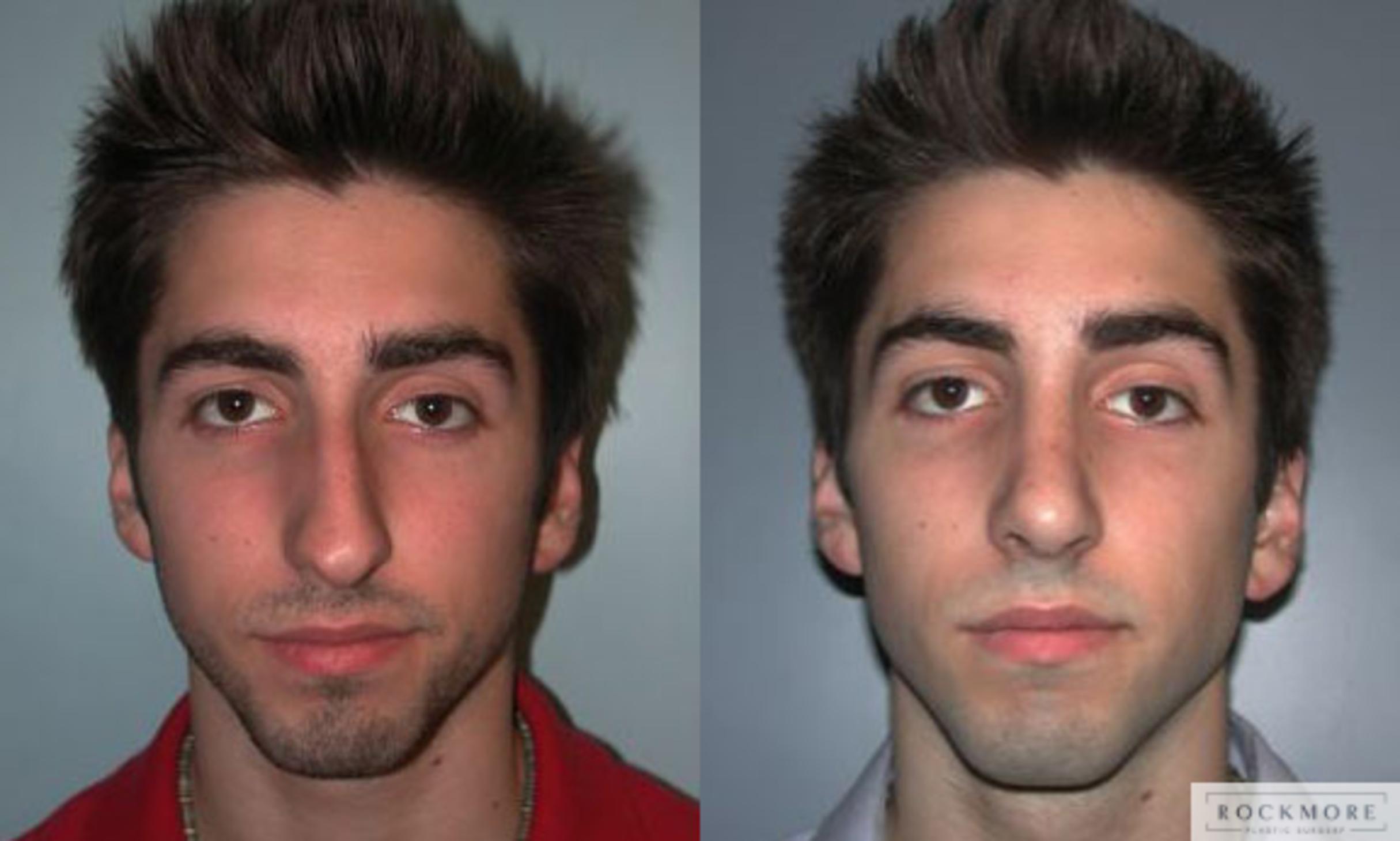 Before & After Rhinoplasty Case 70 View #1 View in Albany, Latham & Saratoga, New York