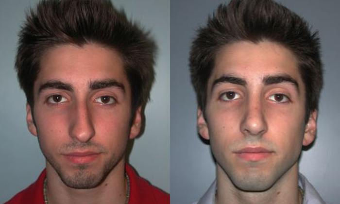 Before & After Rhinoplasty Case 70 View #1 View in Albany, Latham & Saratoga, New York