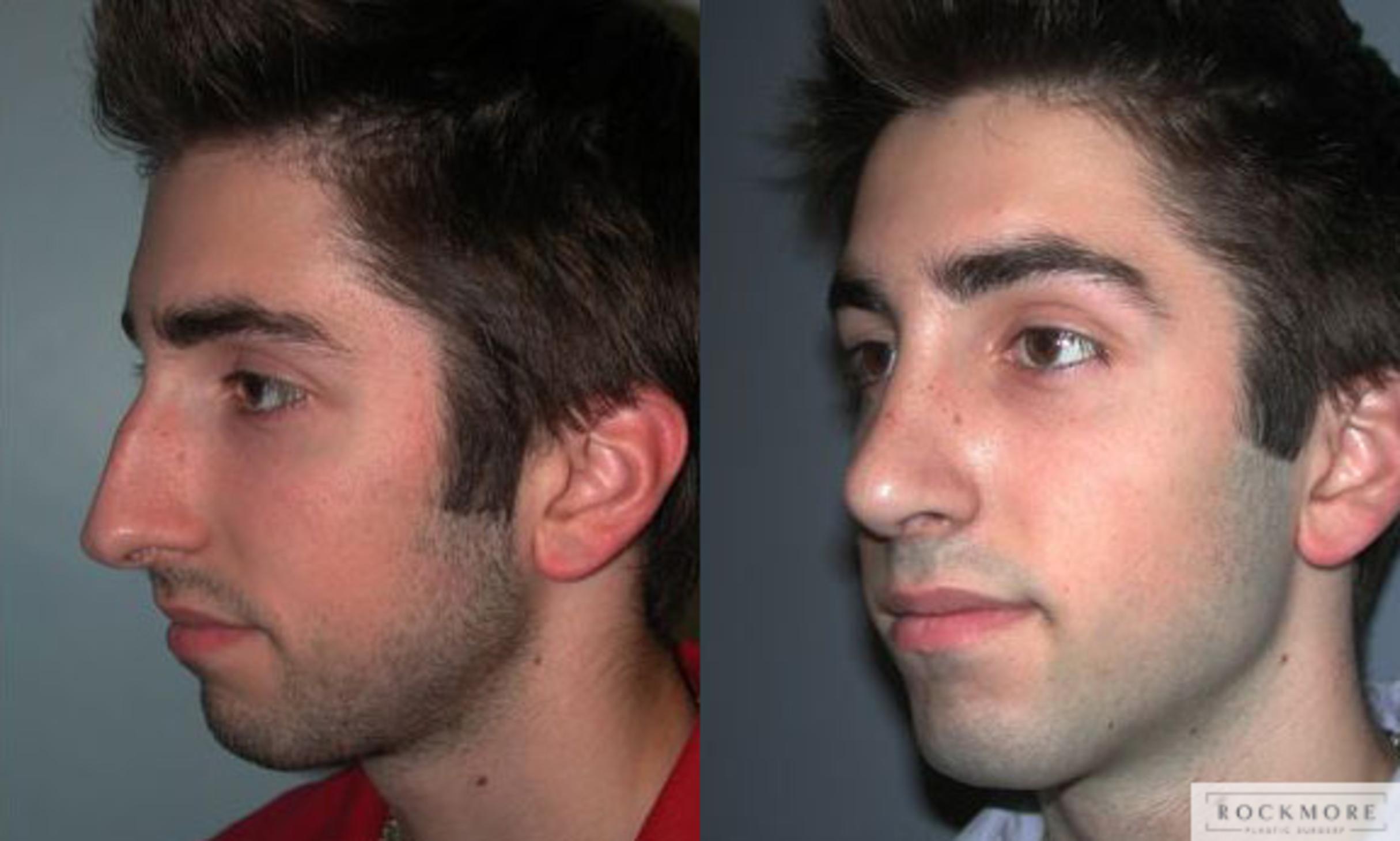 Before & After Rhinoplasty Case 70 View #2 View in Albany & Latham, New York