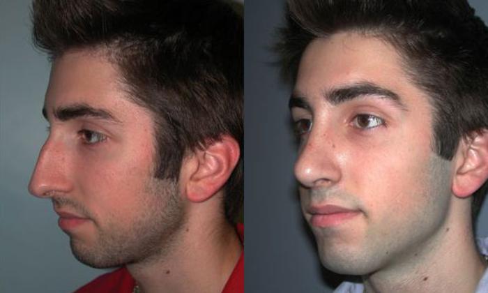 Before & After Rhinoplasty Case 70 View #2 View in Albany, Latham & Saratoga, New York