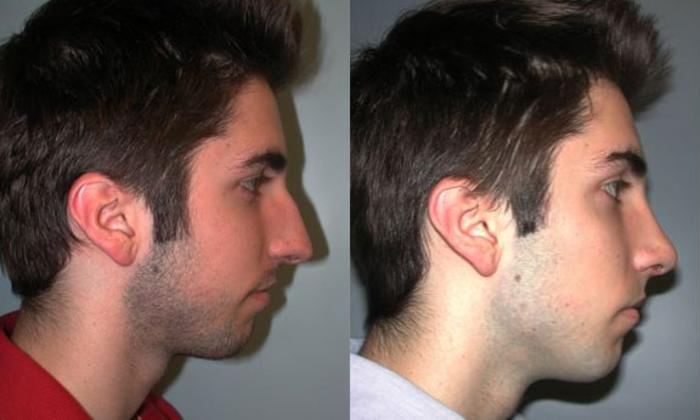 Before & After Rhinoplasty Case 70 View #3 View in Albany, Latham & Saratoga, New York