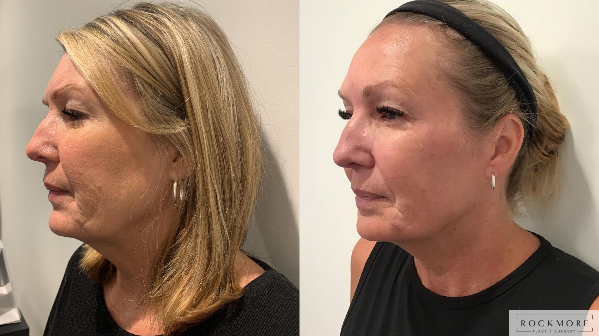 Before & After Secret™ RF Case 389 Left Side View in Albany & Latham, New York