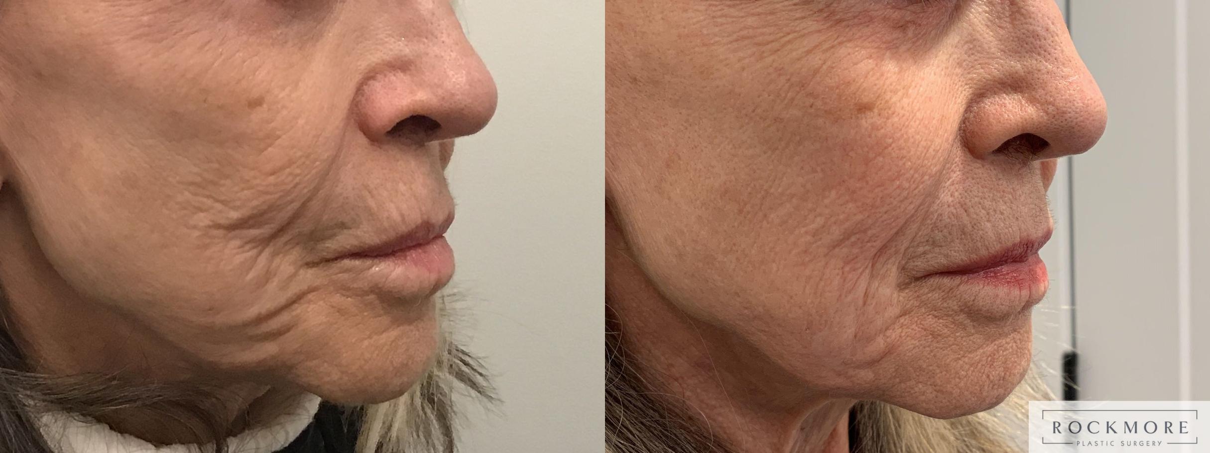 Before & After Secret™ RF Case 390 Right Oblique View in Albany & Latham, New York