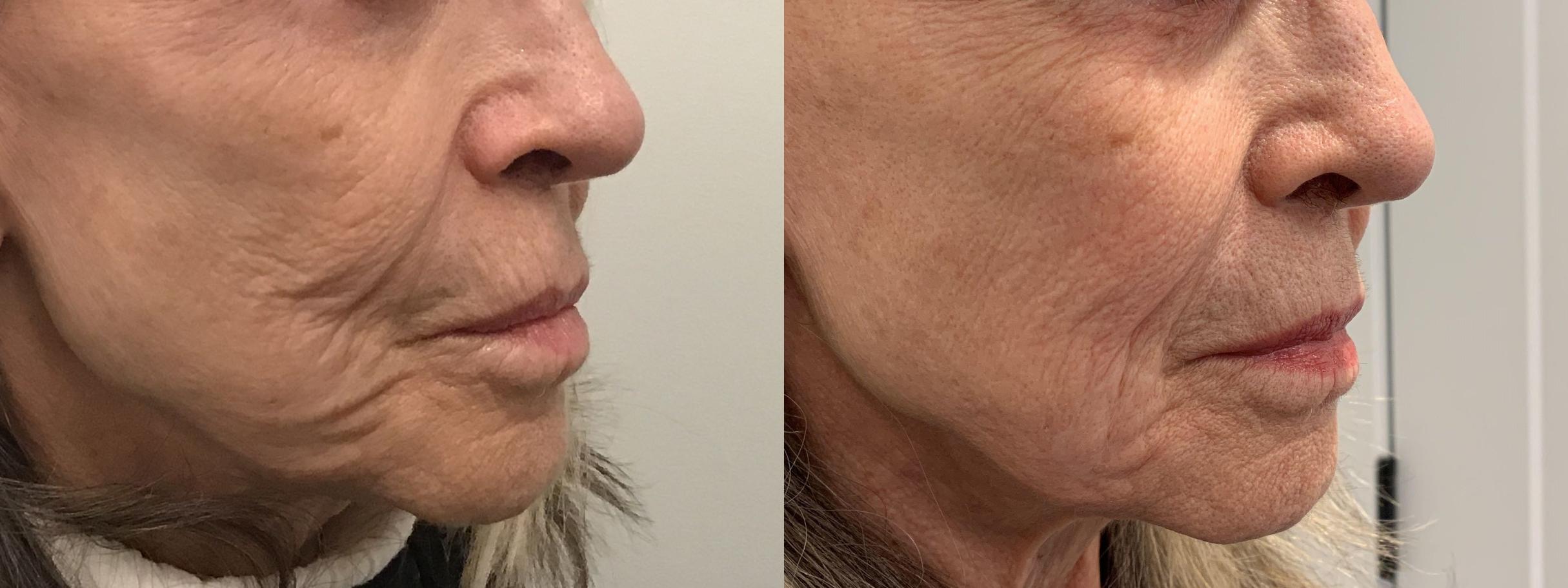 Secret RF Microneedling for Latham Albany Troy NY Rockmore