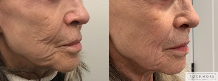 Before & After Secret™ RF Case 390 Right Oblique View in Albany & Latham, New York