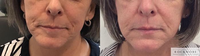 Before & After Secret™ RF Case 424 Front View in Albany & Latham, New York