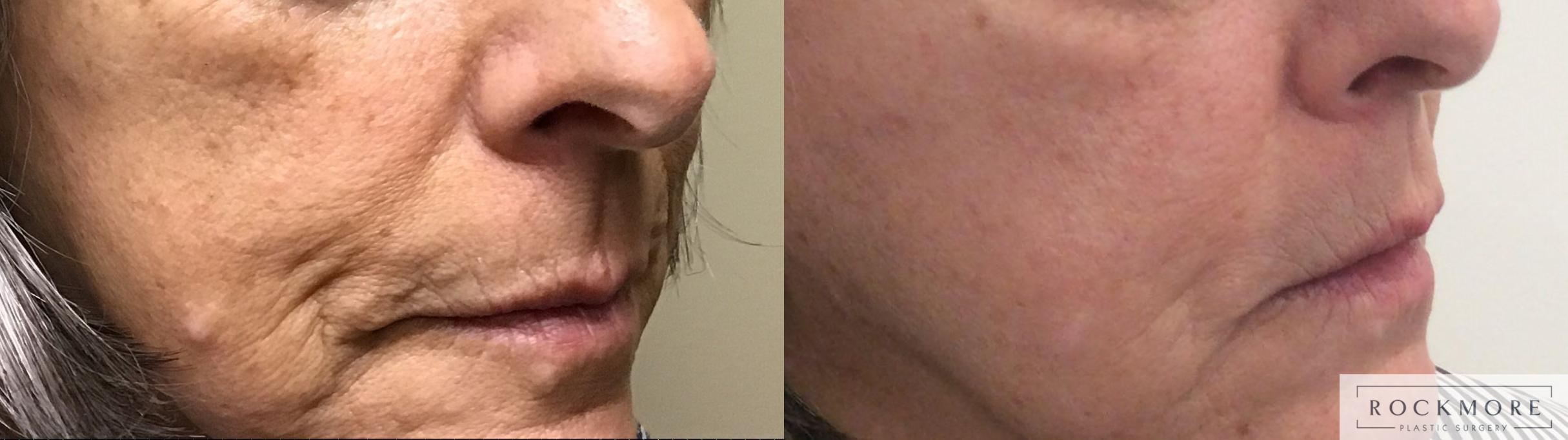 Before & After Secret™ RF Case 424 Left Oblique View in Albany & Latham, New York