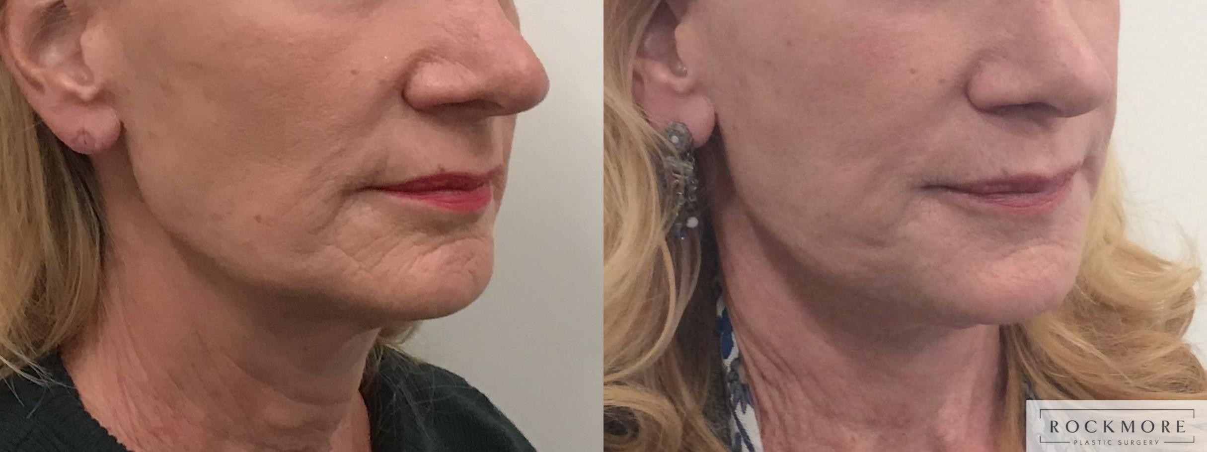 Before & After Secret™ RF Case 448 Left Side View in Albany & Latham, New York