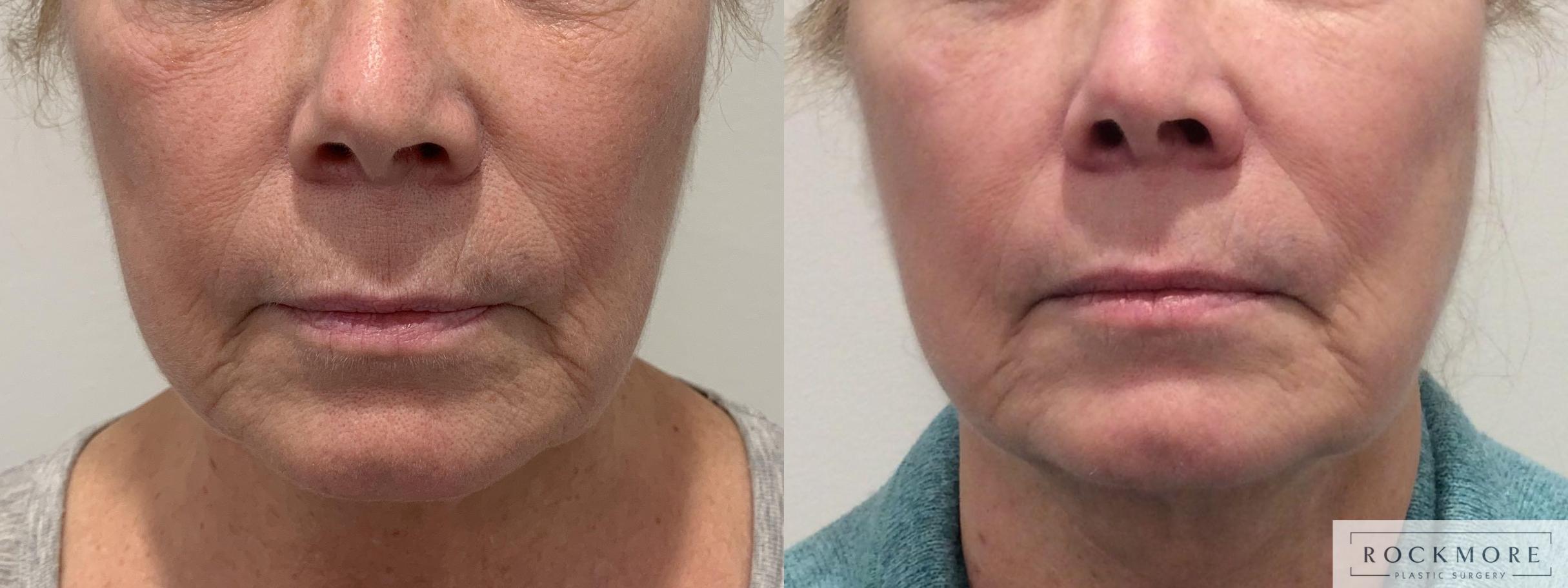 Before & After Secret™ RF Case 449 Front View in Albany & Latham, New York