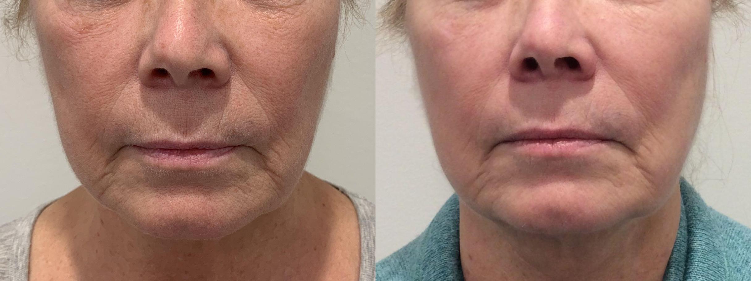 Before & After Secret™ RF Case 449 Front View in Albany & Latham, New York