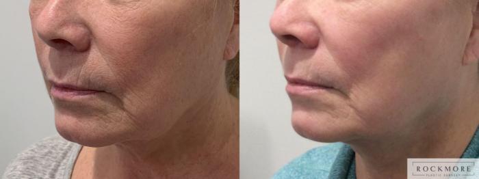 Before & After Secret™ RF Case 449 Left Side View in Albany & Latham, New York