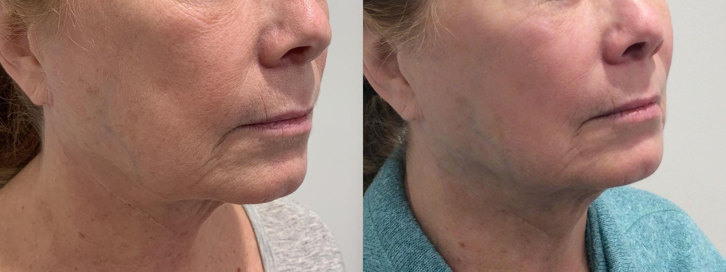 Before & After Secret™ RF Case 449 Right Side View in Albany & Latham, New York