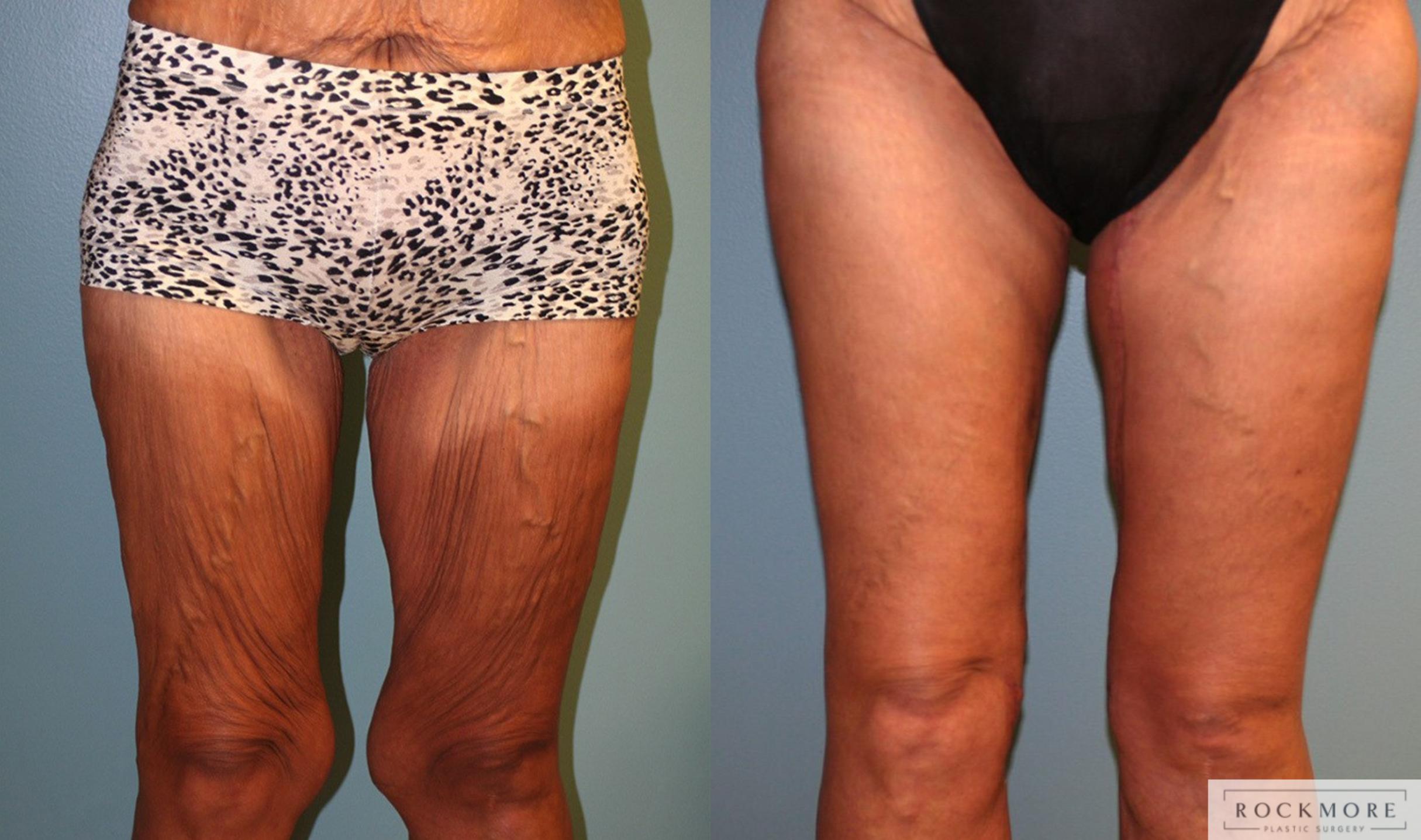 Before & After Thigh Lift Case 161 View #1 View in Albany & Latham, New York