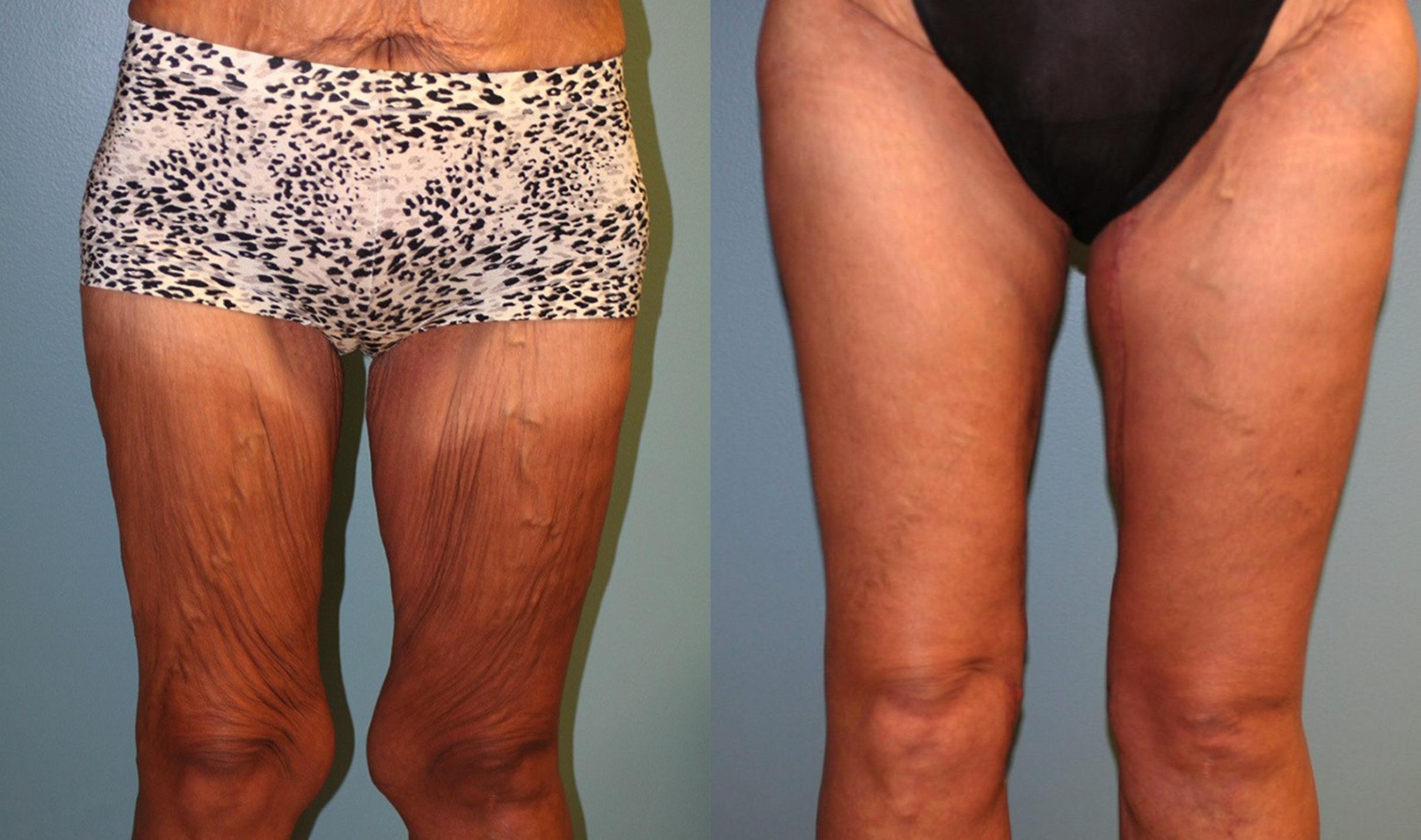 Before & After Thigh Lift Case 161 View #1 View in Albany & Latham, New York