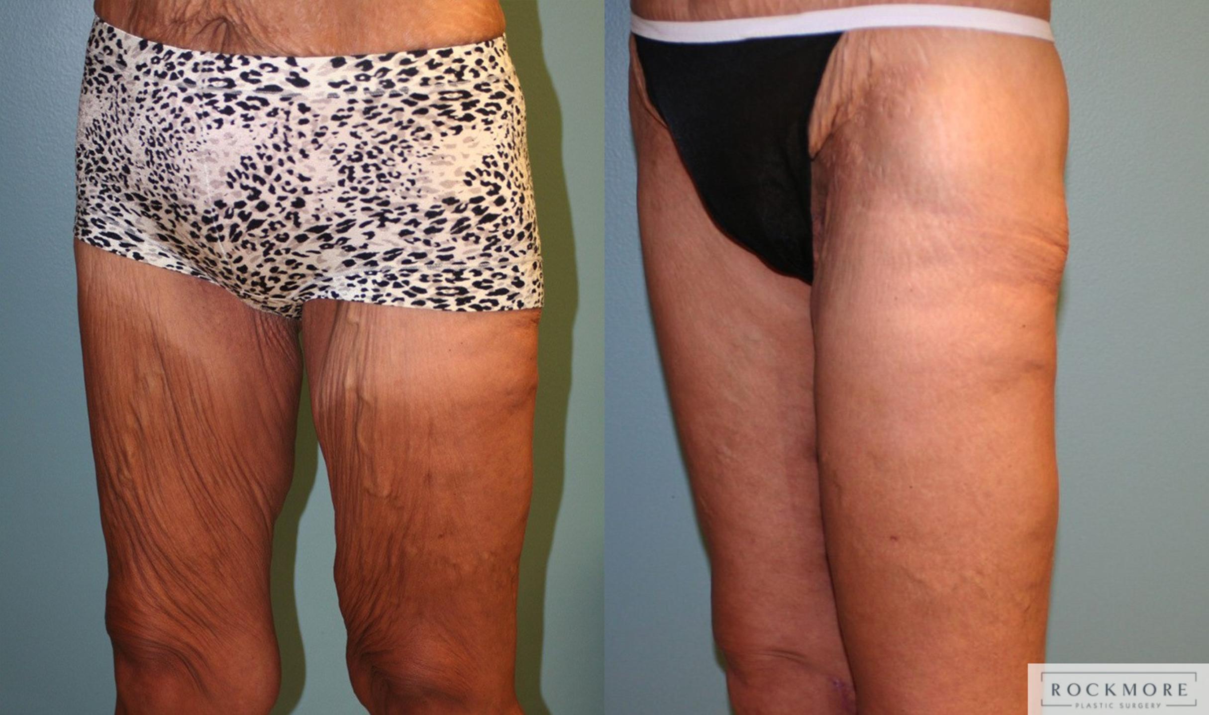 Before & After Thigh Lift Case 161 View #2 View in Albany & Latham, New York