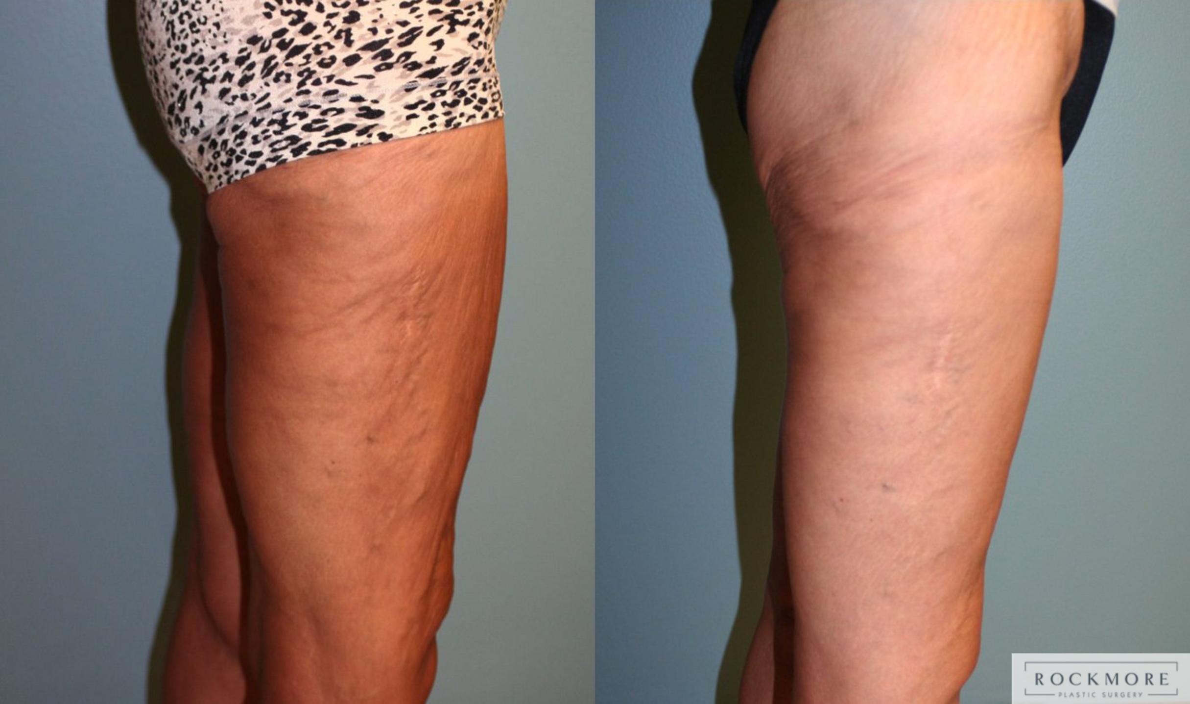 Before & After Thigh Lift Case 161 View #3 View in Albany & Latham, New York