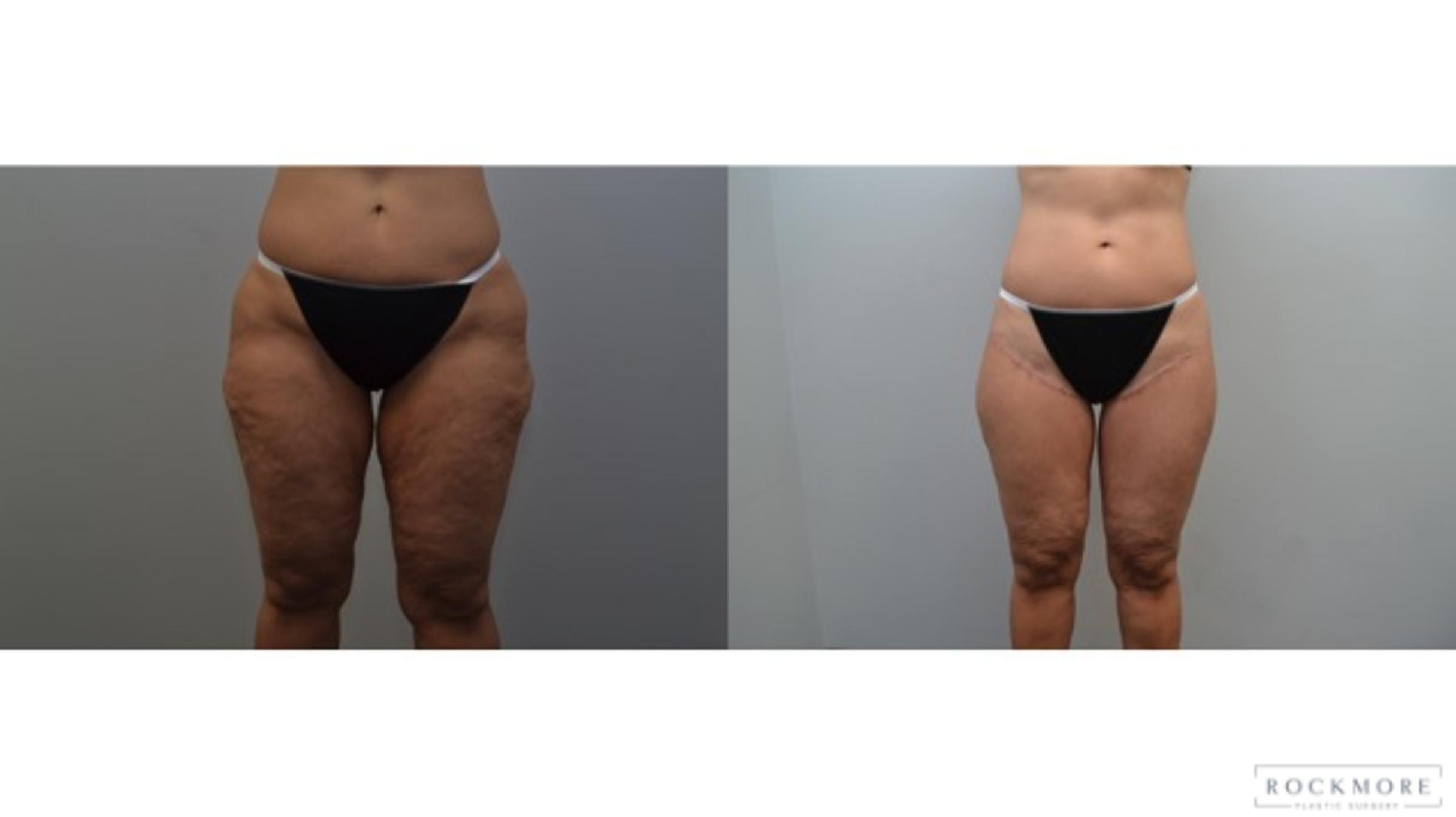 Before & After Thigh Lift Case 233 View #1 View in Albany & Latham, New York