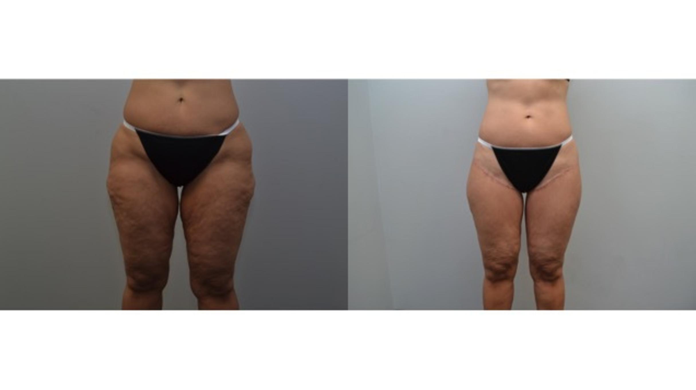 🥇 NYC Thigh Lift (Thighplasty)  Manhattan Thigh Plastic Surgery