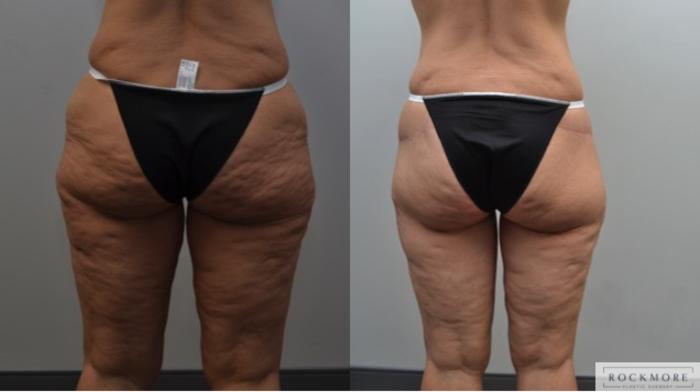 Before & After Thigh Lift Case 233 View #2 View in Albany & Latham, New York