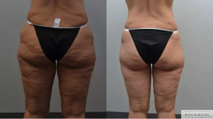 Will Thigh Lift Surgery Remove Cellulite? - Artesia Plastic Surgery  Williamsville, NY