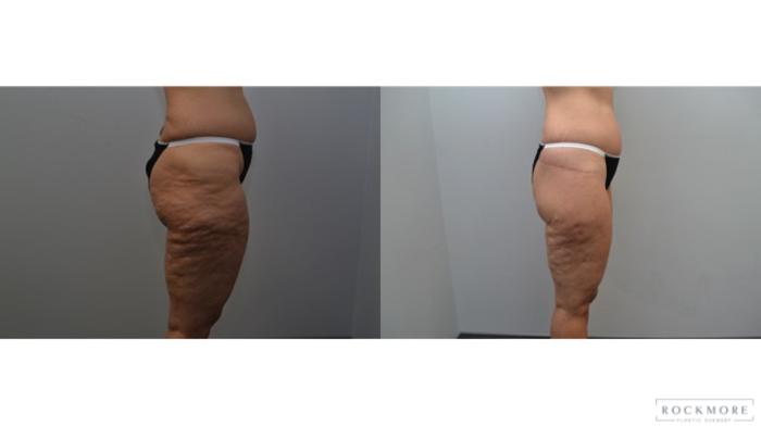 Before & After Thigh Lift Case 233 View #4 View in Albany & Latham, New York