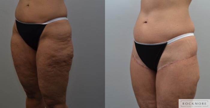 Before & After Thigh Lift Case 233 View #5 View in Albany & Latham, New York