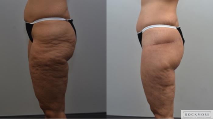 Before & After Thigh Lift Case 233 View #6 View in Albany & Latham, New York