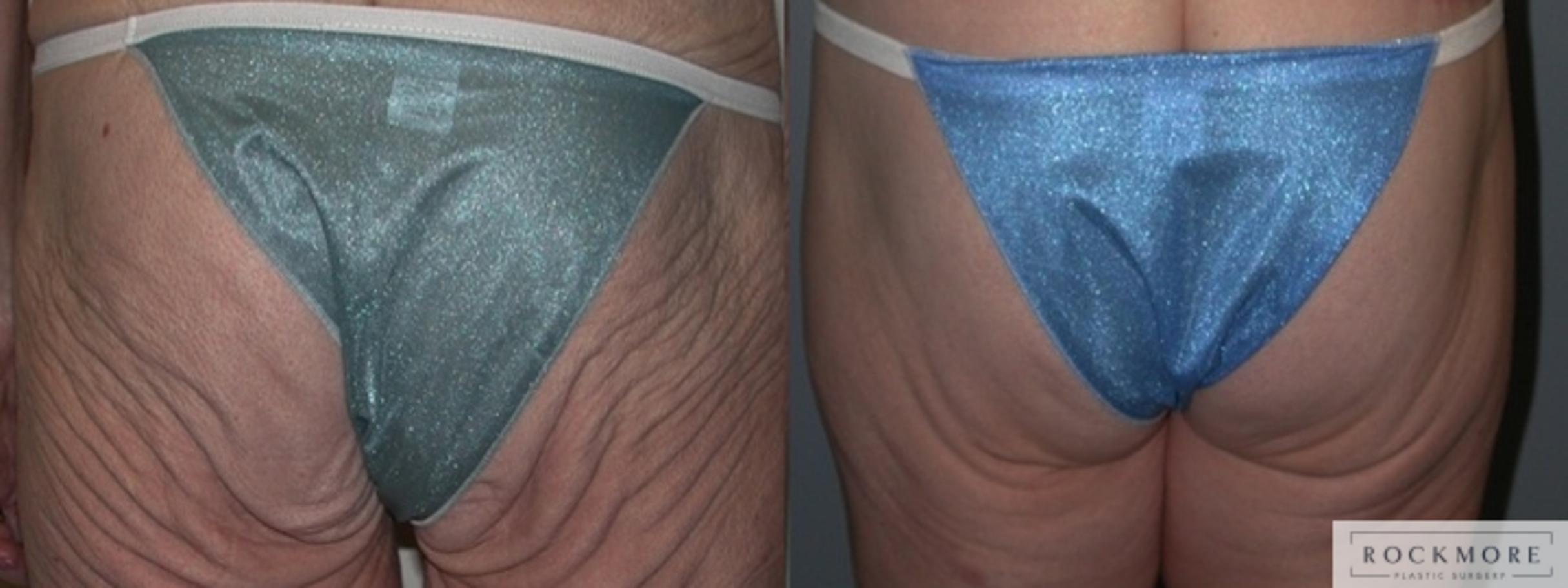 Before & After Thigh Lift Case 32 View #1 View in Albany & Latham, New York
