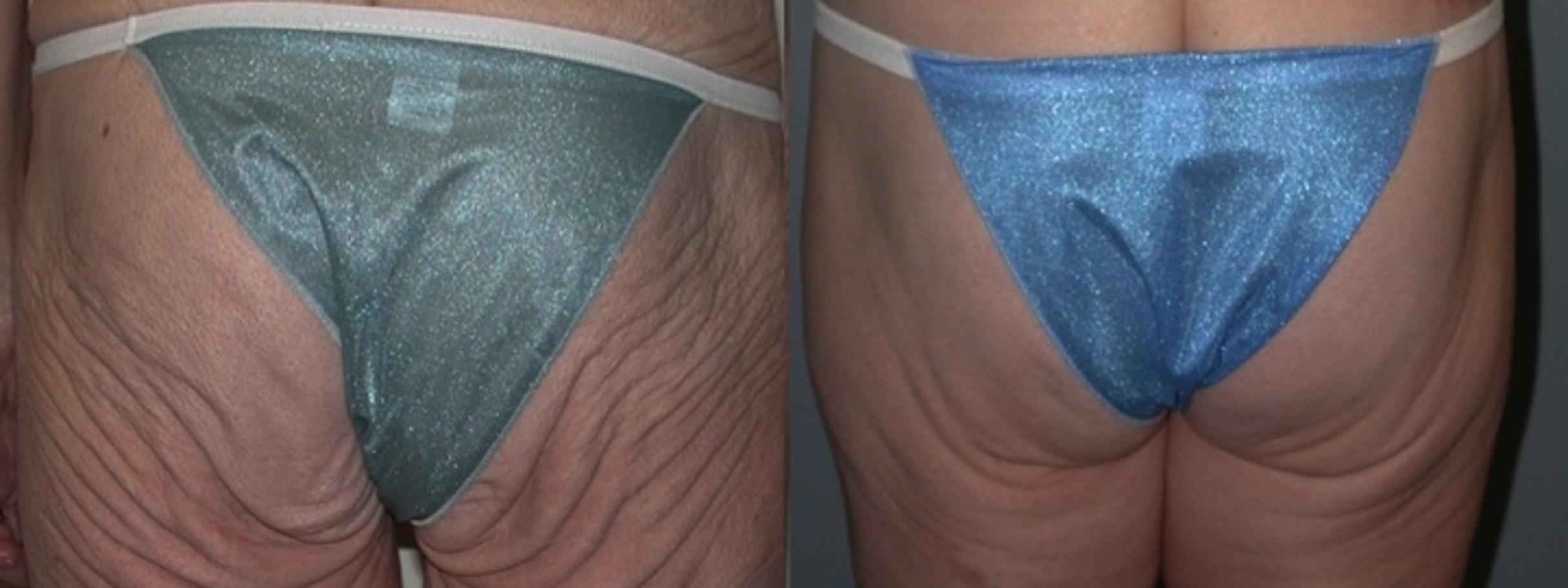 Before & After Thigh Lift Case 32 View #1 View in Albany & Latham, New York