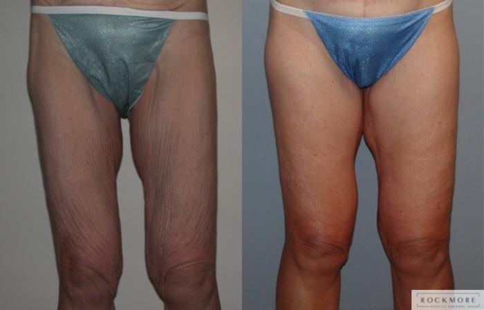 Before & After Thigh Lift Case 32 View #2 View in Albany & Latham, New York
