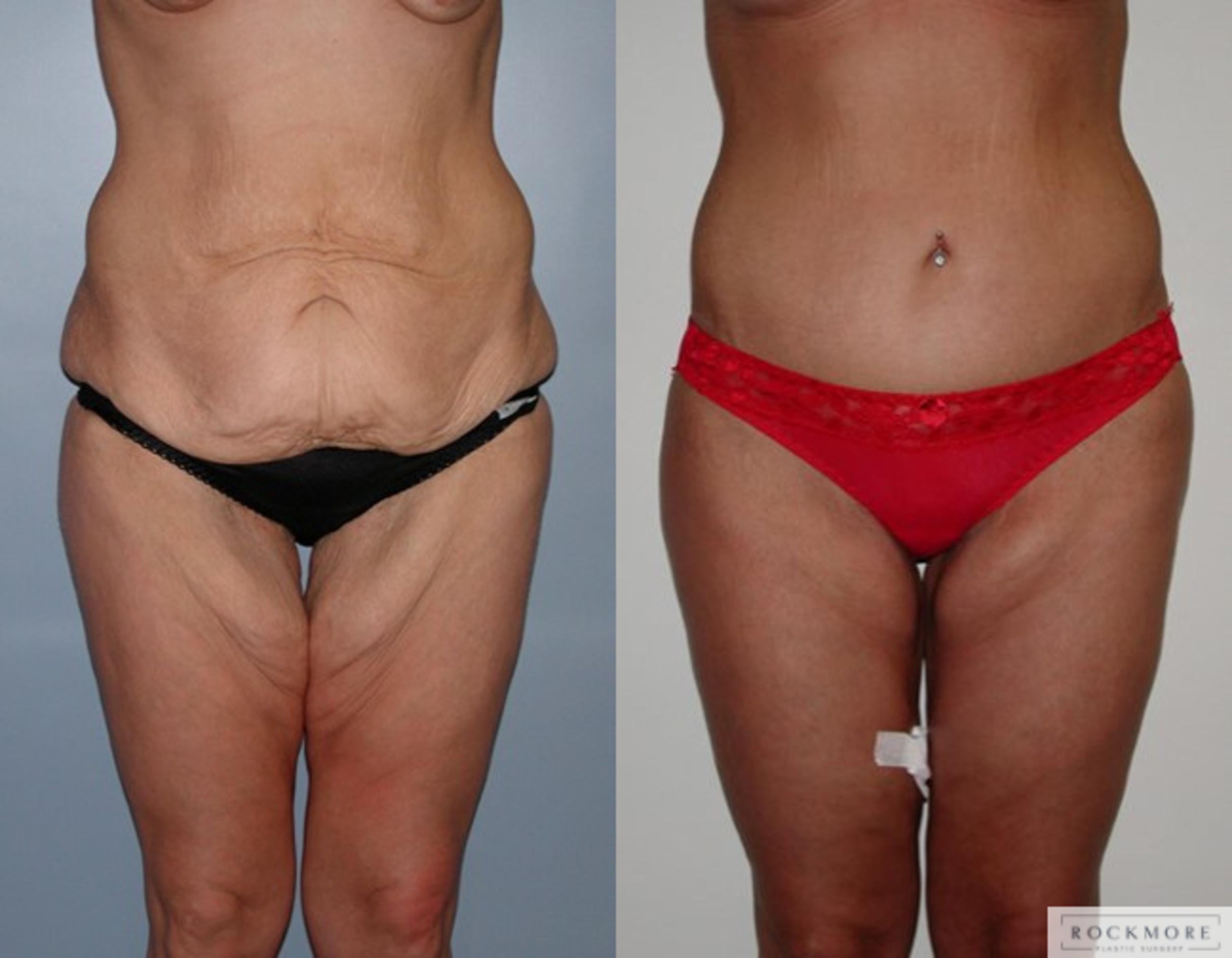 Before & After Thigh Lift Case 34 View #1 View in Albany & Latham, New York