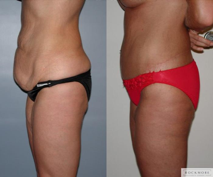 Before & After Thigh Lift Case 34 View #2 View in Albany & Latham, New York