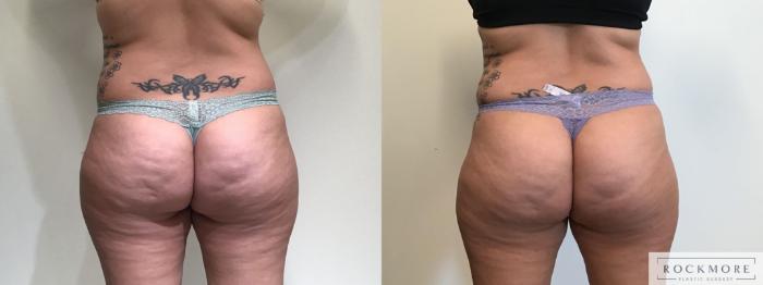 Before & After truSculpt® Case 395 Back View in Albany & Latham, New York
