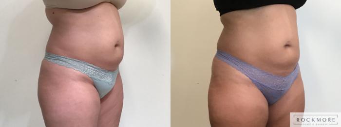 Before & After truSculpt® Case 395 Right Oblique View in Albany & Latham, New York