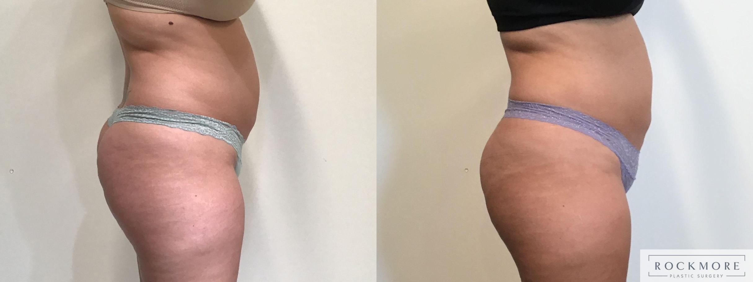 Before & After Non-Invasive Fat Removal Case 395 Right Side View in Albany & Latham, New York