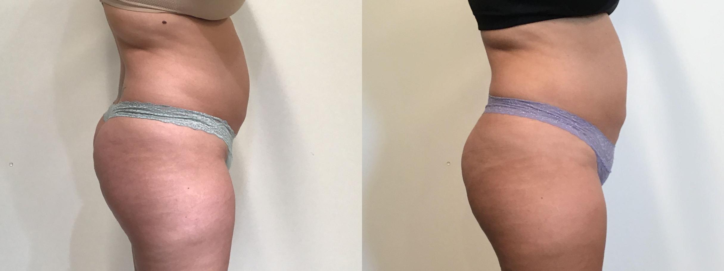 Before & After truSculpt® Case 395 Right Side View in Albany & Latham, New York