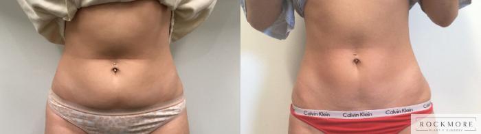 Before & After truSculpt® Case 421 Front View in Albany & Latham, New York