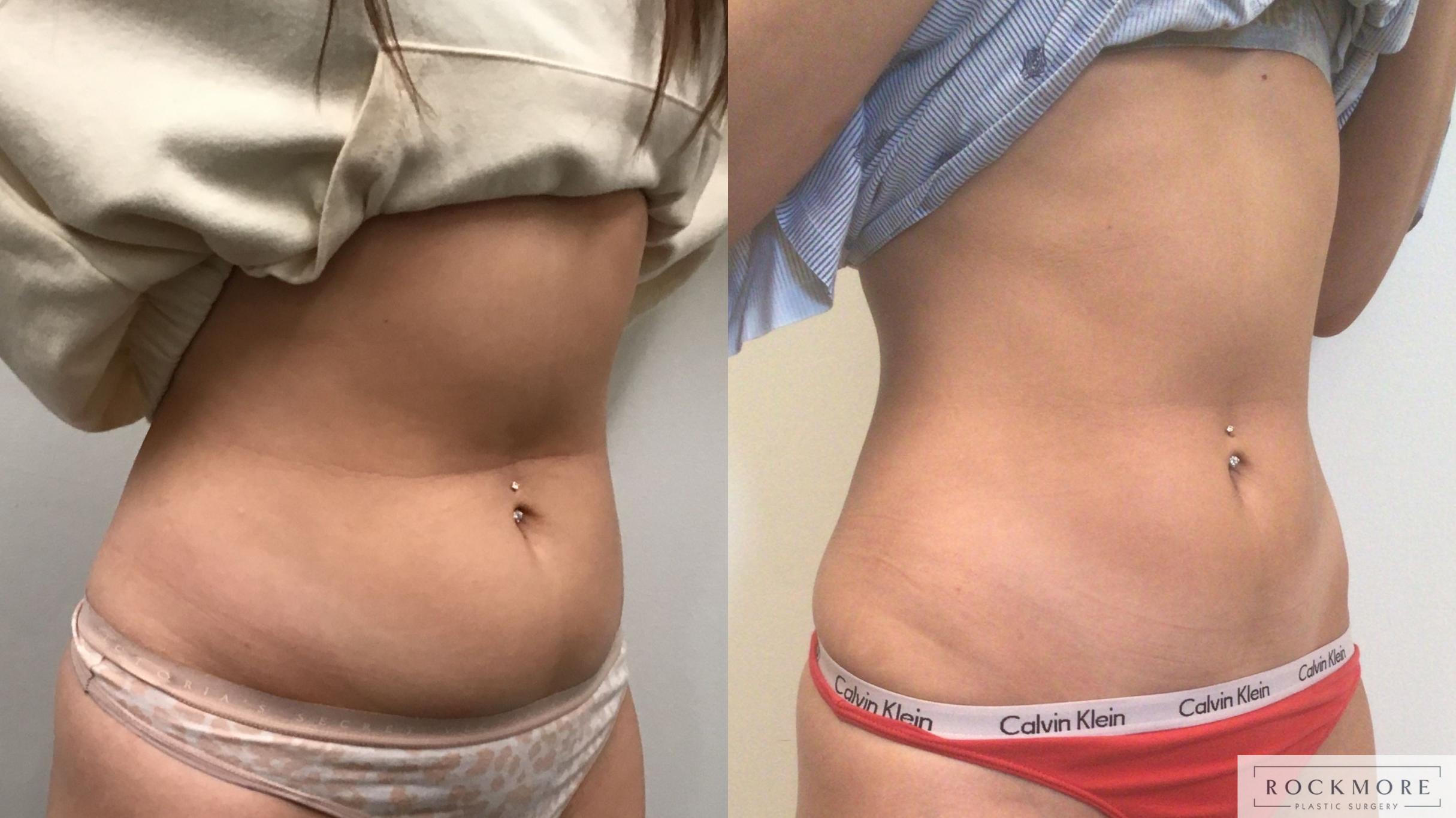 truSculpt® Before and After Pictures Case 421 | Albany & Latham, New York |  Rockmore Plastic Surgery