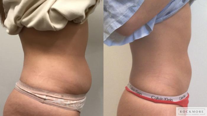 Before & After truSculpt® Case 421 Left Side View in Albany & Latham, New York