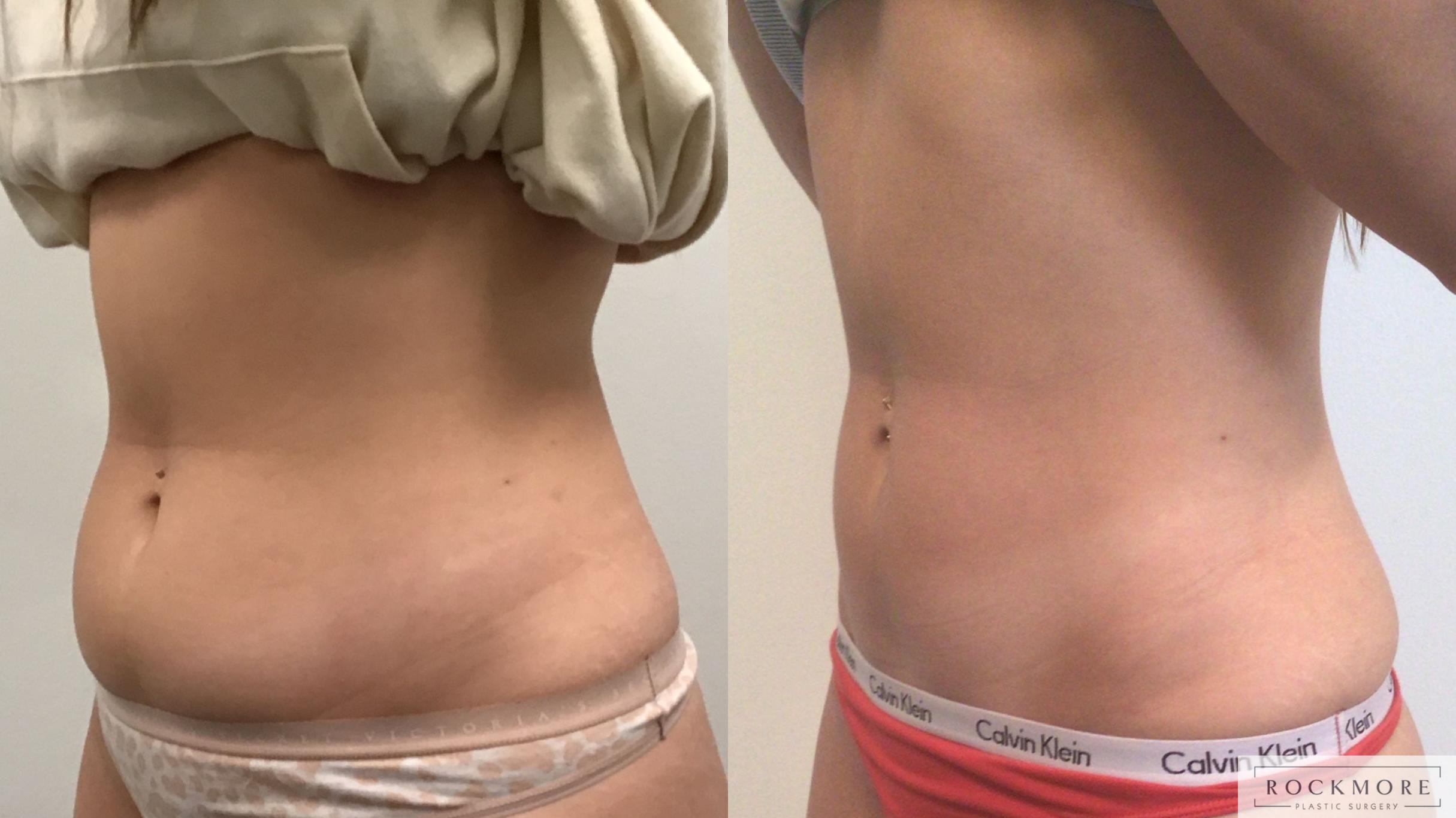 Before & After truSculpt® Case 421 Right Oblique View in Albany & Latham, New York
