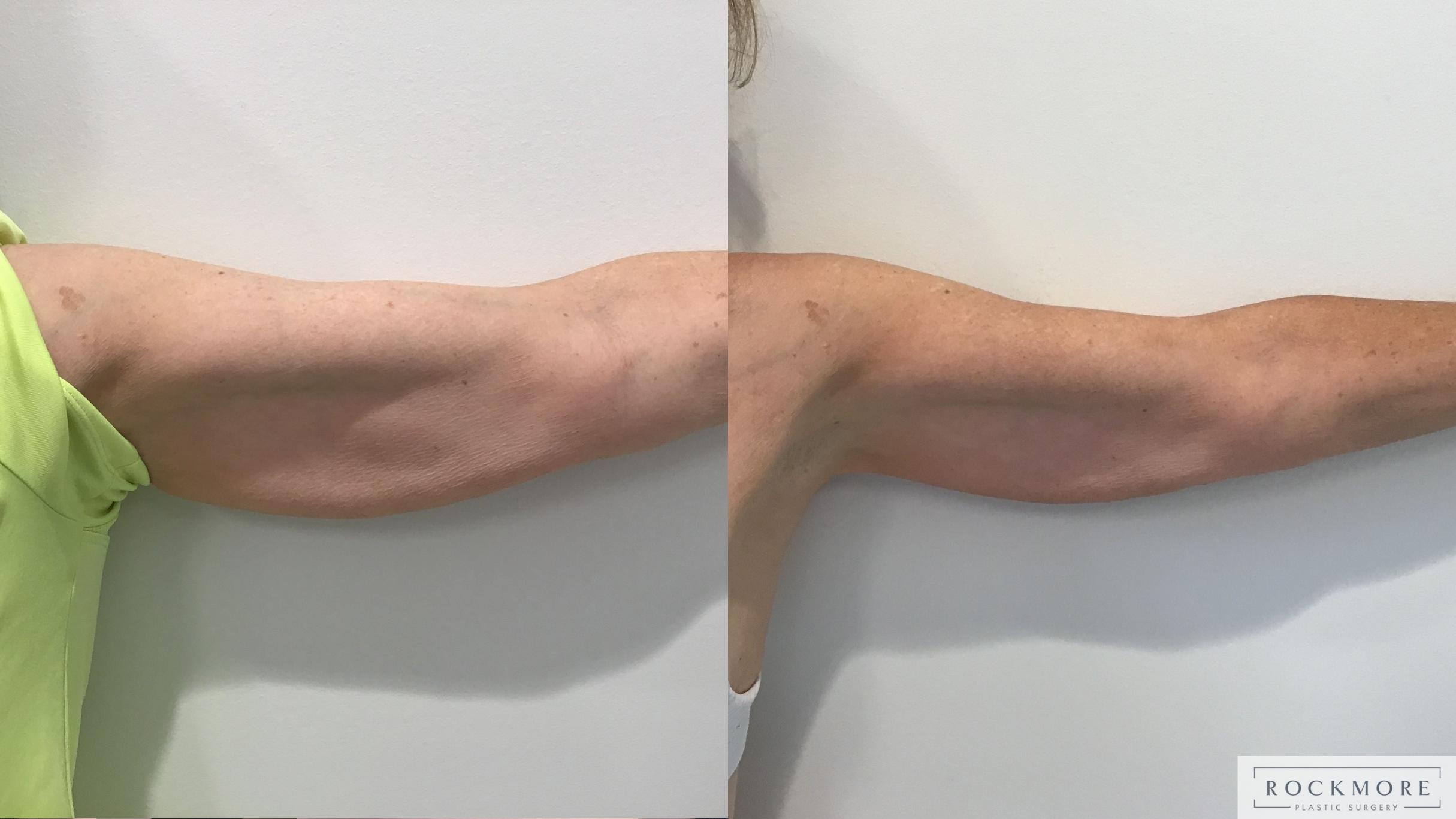 Before & After truSculpt® Case 422 Back View in Albany & Latham, New York