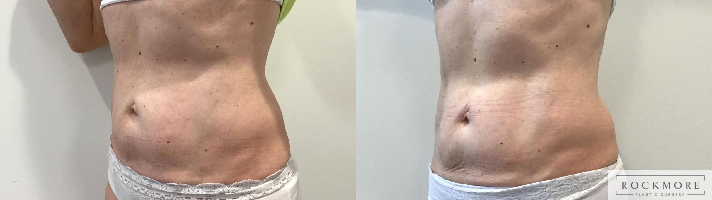 Before & After truSculpt® Case 423 Left Oblique View in Albany & Latham, New York