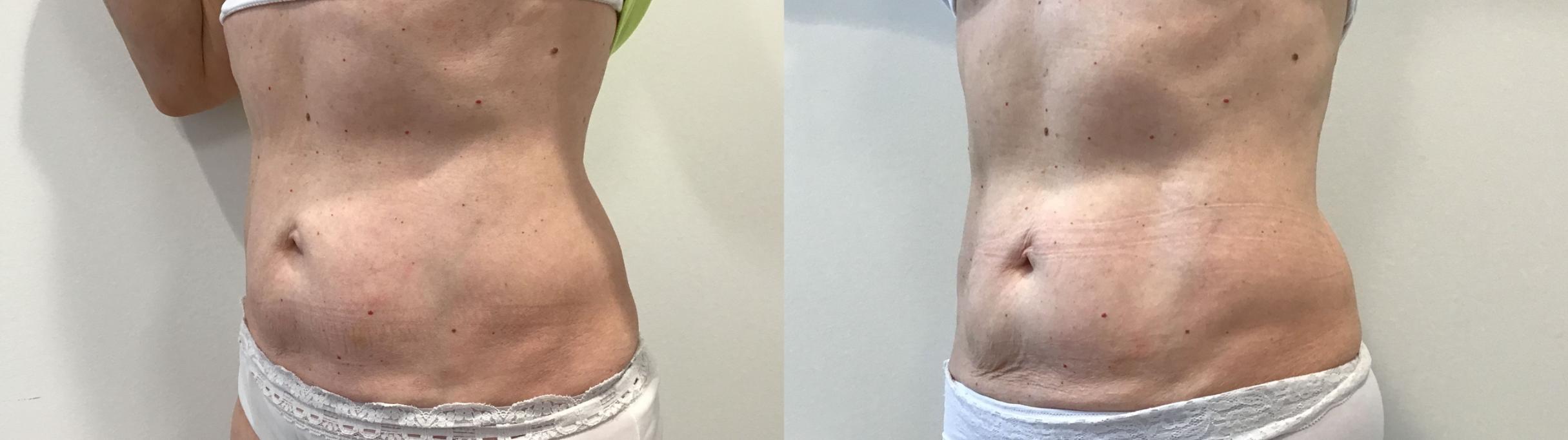 Before & After truSculpt® Case 423 Left Oblique View in Albany, Latham & Saratoga, New York