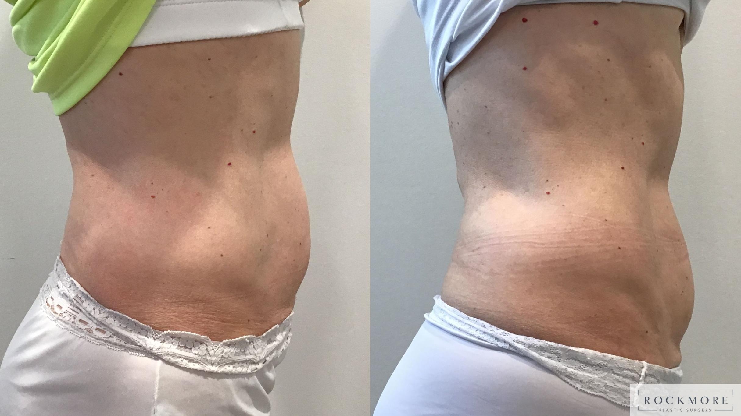 Before & After truSculpt® Case 423 Right Side View in Albany & Latham, New York
