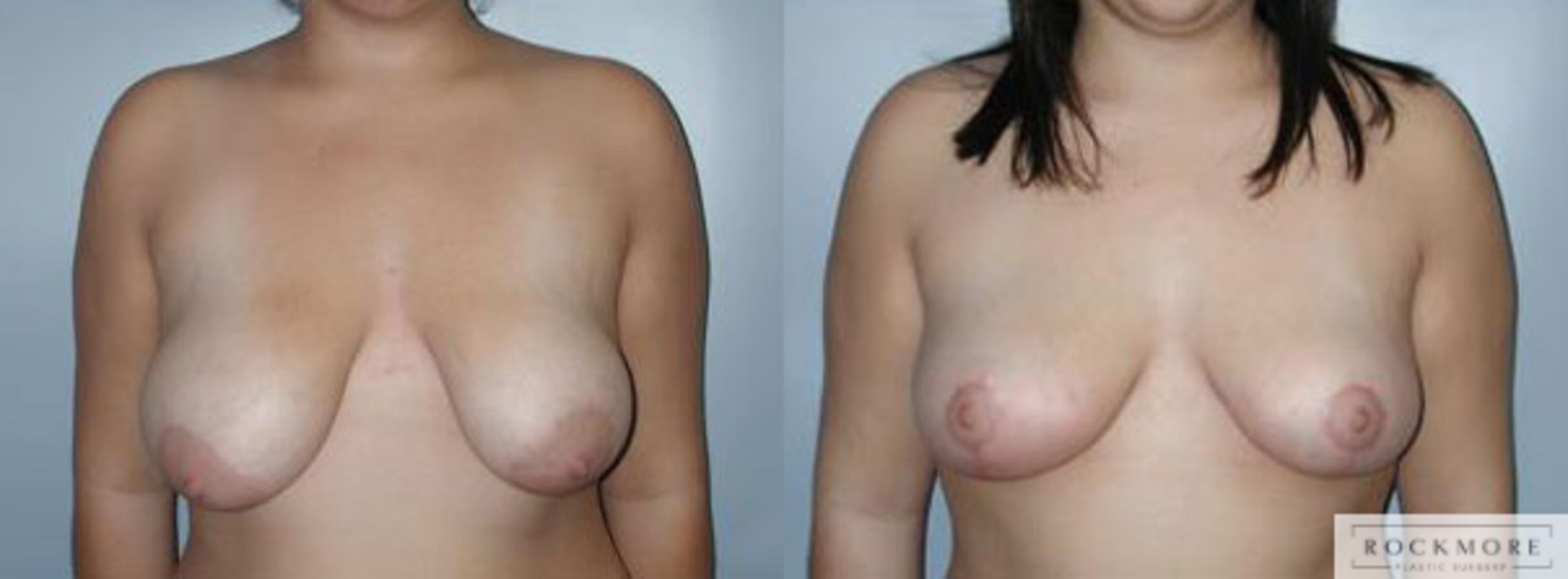 Before & After Tubular Breasts Case 103 View #1 View in Albany & Latham, New York