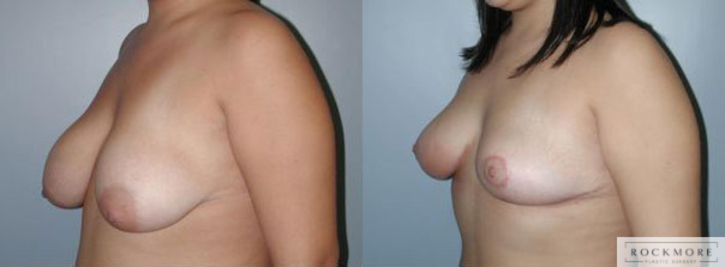 Before & After Tubular Breasts Case 103 View #2 View in Albany & Latham, New York